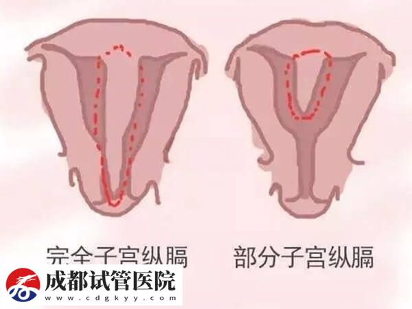纵隔子宫的危害除了反复流产还有什么?(图1) 纵隔子宫的危害除了反复流产还有什么?(图1)